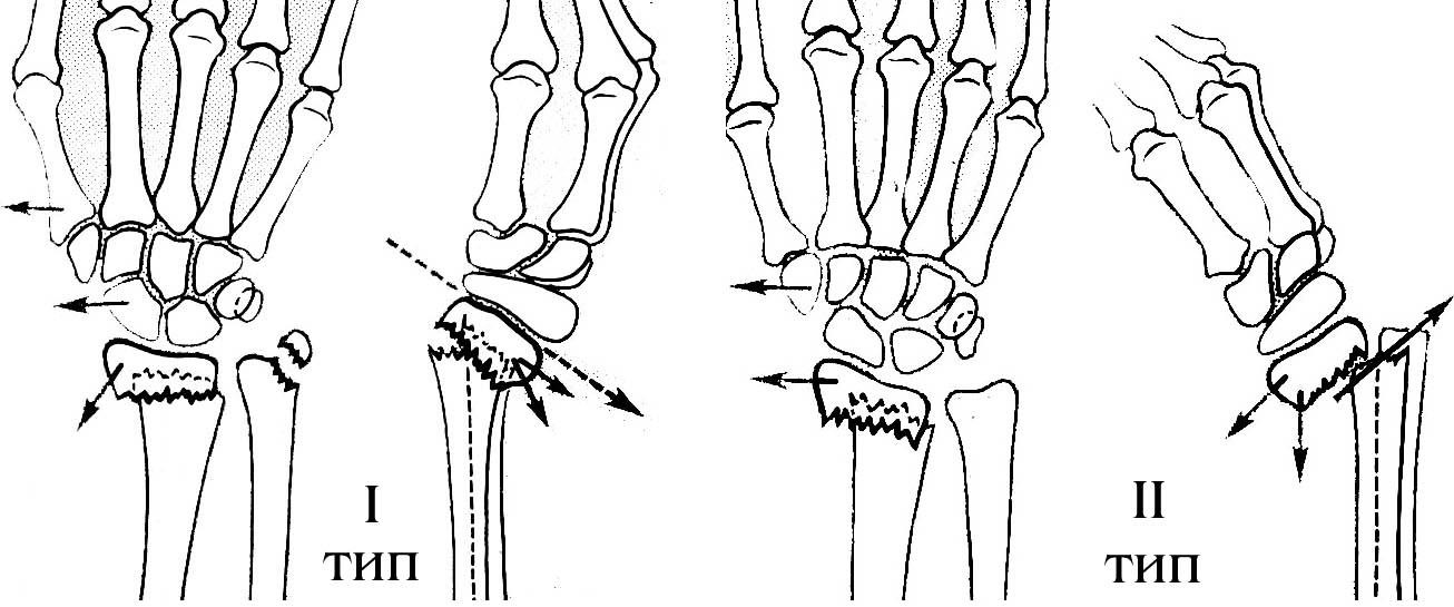 Перелом лучевой кости в типичном месте карта вызова смп