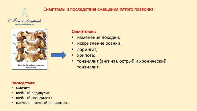 Признаки позвоночника. Смещение 2 шейного позвонка симптомы. Смещение позвонков симптомы. Смещение шейных позвонков симптомы. Смещение позвонка симптомы.