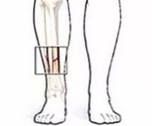 Боль в голени спереди причины. Болит кость на ноге ниже колена. Болит кость голени спереди. Кость ниже колена спереди. Болят кости голени спереди.