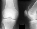 What is the purpose of a knee x-ray?