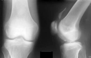 З якою метою роблять рентген колінного суглоба