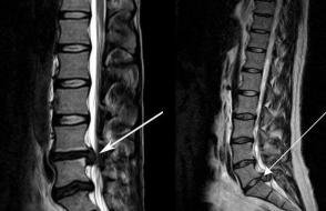 Hvordan behandle lumbal spinal brokk 3